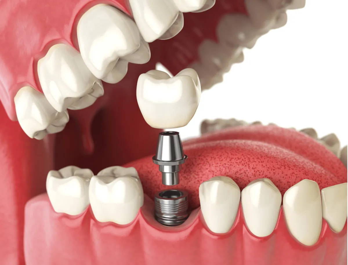 Comprehensive Guide to Dental Implants