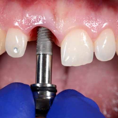 dentist near me, dental implant cost, bangalore